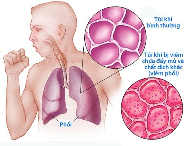 Mùa lạnh là thời điểm bùng phát dịch cúm và số người bị viêm phổi tăng cao