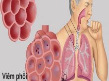Viêm phổi mùa lạnh