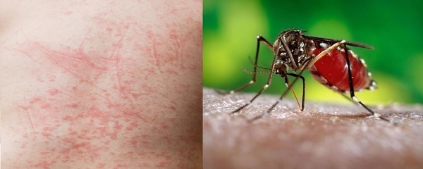 Cách giảm nguy cơ mắc bệnh sốt xuất huyết Dengue